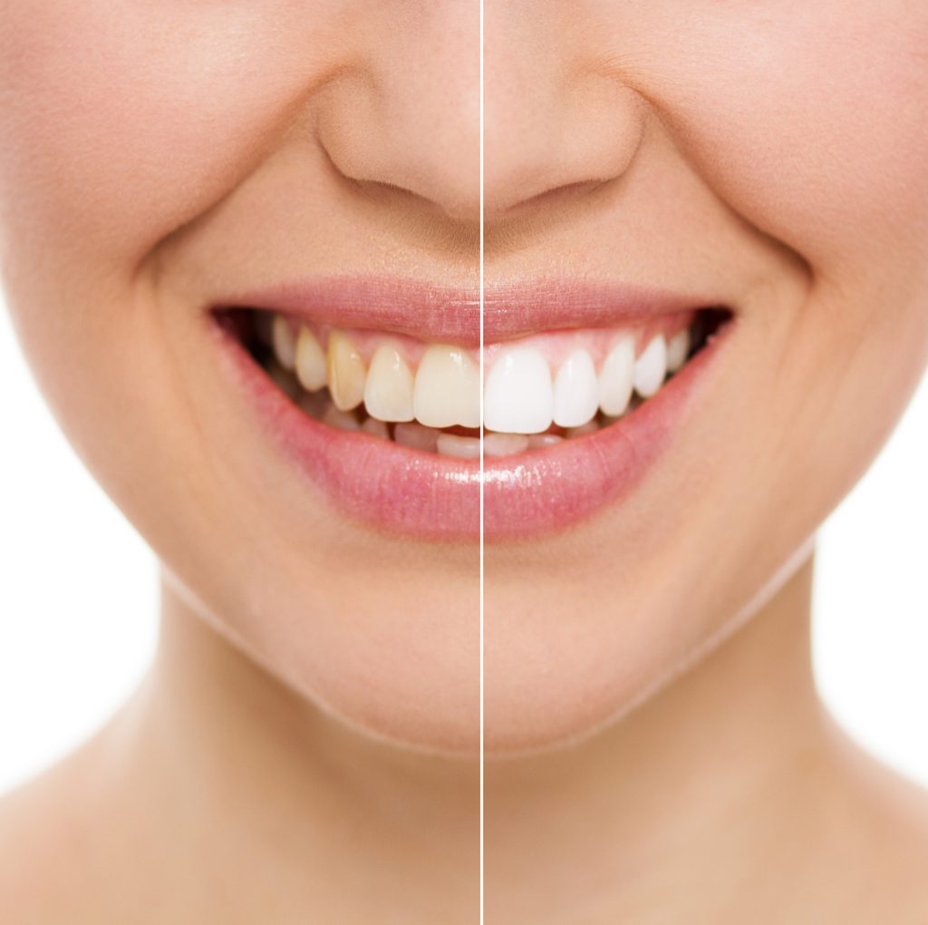 KöR Teeth Whitening Eliminates Stains And Makes Your Smile Radiant ...